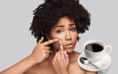 Uống c&agrave; ph&ecirc; c&oacute; nổi mụn kh&ocirc;ng? C&aacute;ch uống cafe hạn chế nổi mụn